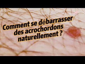 Comment se débarrasser des acrochordons naturellement ?