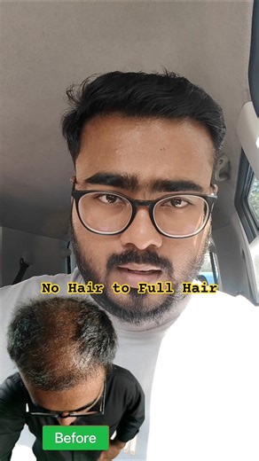 From Bald to Full Hair! Real Hair Growth Transformation | Grow Back Hair