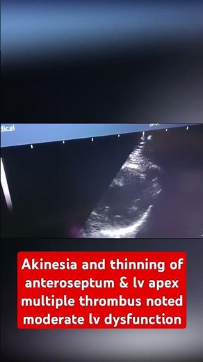 lv apex multiple thrombus & moderate lv dysfunction