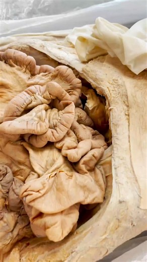 How Medical Works on Instagram: "The Hidden Tube That Makes Male Reproduction Possible 👀 Ever wondered how sperm actually gets from the testes to where it needs to go? Let me show you something most people have never seen. Video Credit: @instituteofhumananatomy #educational #explore #viral #reels #medical"