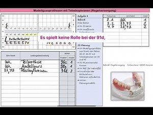 3/3 Modellgussprothese mit Teleskopkronen BEMA-Positionen für die Regelversorgung
