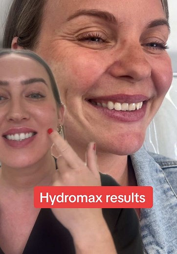 Hydromax Treatment for Lower Face Laxity and Lines