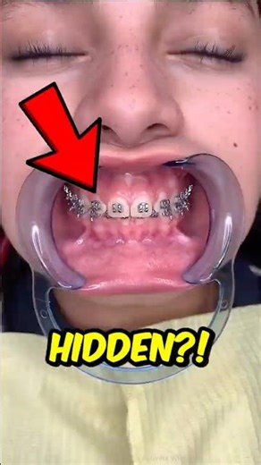 Braces: The Hidden Truth