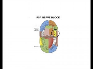 Posterior Superior Alveolar Nerve Block Injection