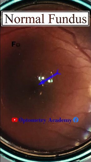 Normal fundus | Normal Retina | Smartphone Fundus Videography | Fundus Photography | Short Video 488