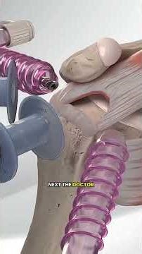 Torn Rotator 🇱🇷 Cuff? See How Surgery Fixes It! 🏥