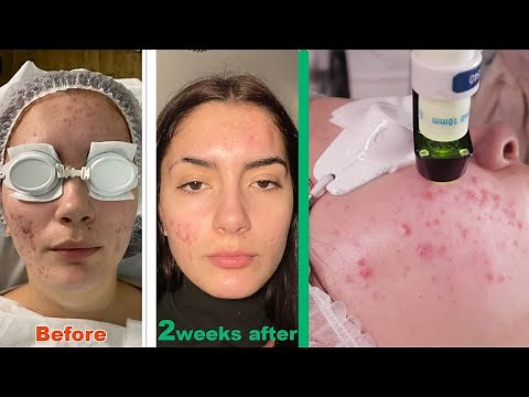 Clear skin laser treatment for ACNE - 2022 bespoke acne innovation treatment that actually works