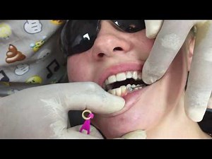 Overbite Correction - Carriere Class III & Zendura