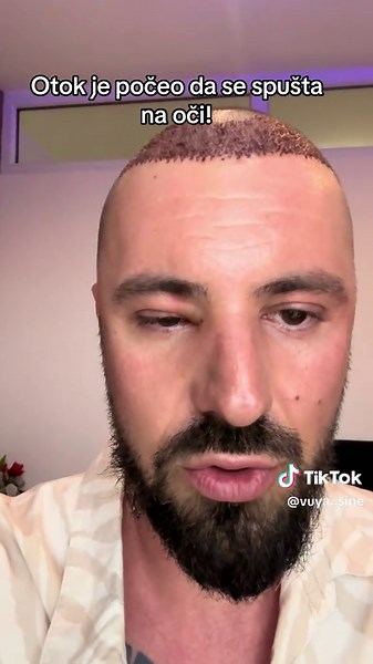 Otok se spušta na oči: Efekti transplantacije