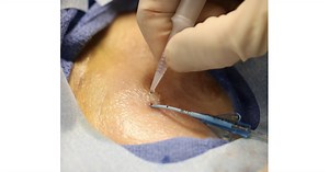 2021 INS Standards Recognize SecurePortIV® Tissue Adhesive as Standard of Care