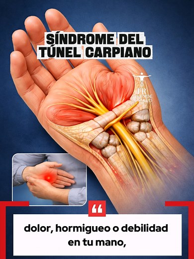 Síndrome del túnel carpiano: Prevención y cuidados