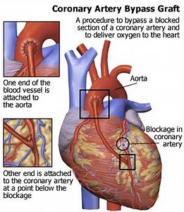 Minimally Invasive Coronary Artery Bypass | Heart Surgery Info