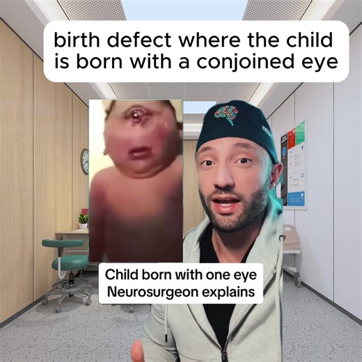 This is a rare defect where a child can be born with a conjoined eye and no midline features to the brain. 🧑‍⚕️ 🧠 #neurosurgery #neurosurgeon #holoprosencephaly #holoprosencephalyawareness #cyclopia