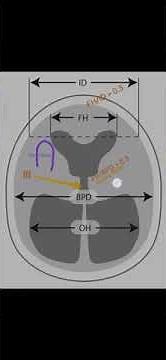 How to diagnose hydrocephalus on CT/MRI?