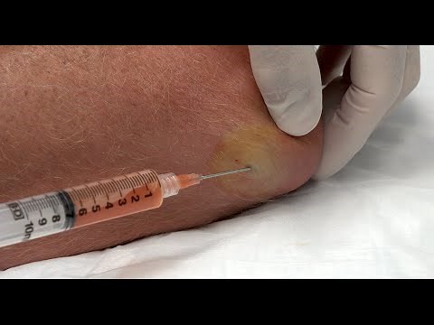 Elbow Effusion Aspirated for Sudsy! Olecranon Bursitis Effusion