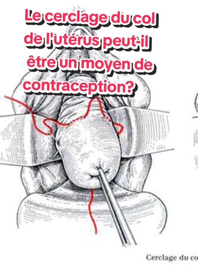 Le cerclage du col : une méthode de contraception ?