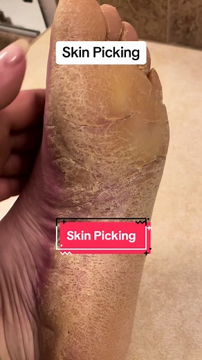 Effective Callus Removal for Dry Skin on Feet