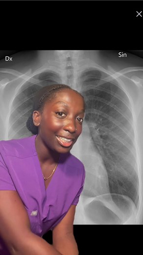 Basics of How to Read a Chest X-Ray Explained
