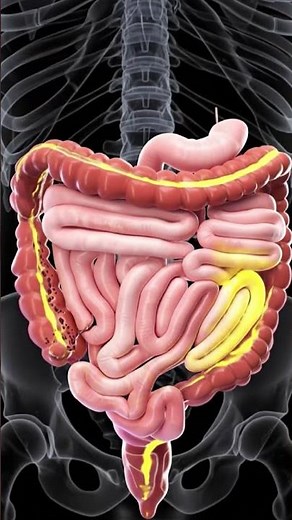 3D Animation of Constipation Explained | Gut Health