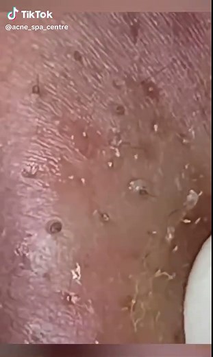 Acne Spa Centre on TikTok