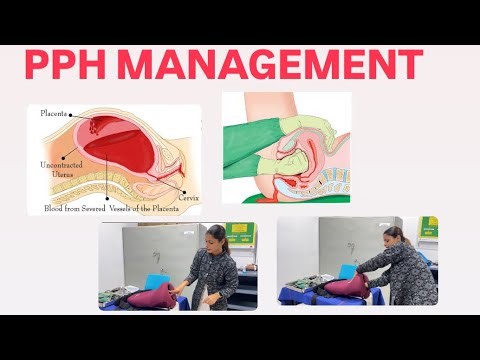 INITIAL MANAGEMENT OF PPH