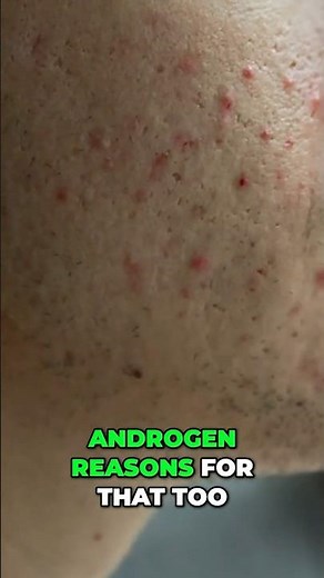 Acne, Androgens & Healing Natural Solutions Explained