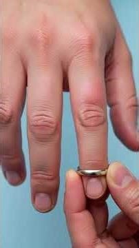 Hot Oil Burn — What REALLY Happens Under Your Skin 🔥 | #burninjury | #staysafe | #health