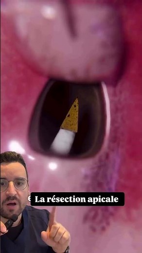 Apical resection: the last chance to save a threatened tooth?