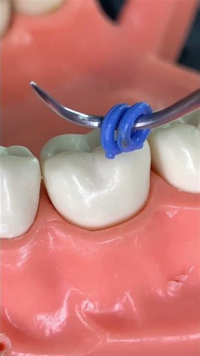 🔥¿Cuál Fue tu Experiencia con los Separadores Elásticos?🔥