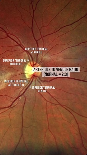 Funduscopic Exam (Ophthalmoscopy) Guide