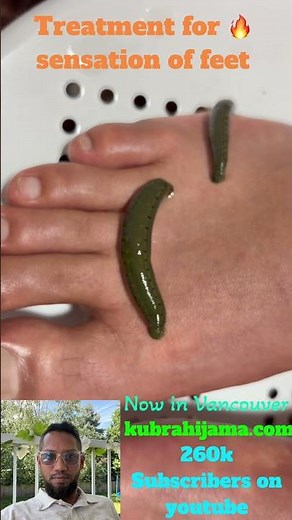 🔥 Burning Feet & Plantar Fasciitis Relief Naturally | Hijama & Holistic Treatment | Dr. Salman