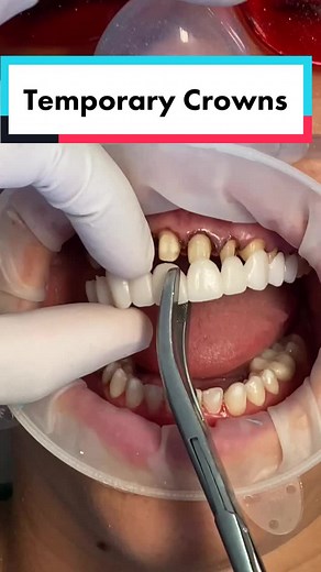 #temporary #crowns #removal #replacement #teeth #dentist #dental #dentistry #cosmetic