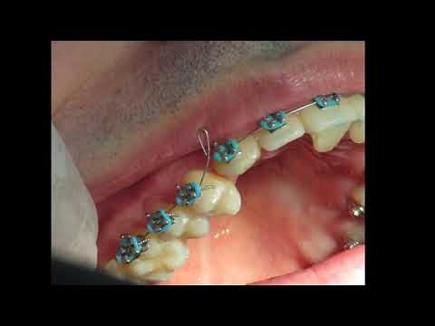 Se te sale el alambre de los brackets?? Mira la solución !! Un tope de resina 😎✌