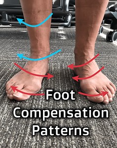 Foot Compensation Patterns