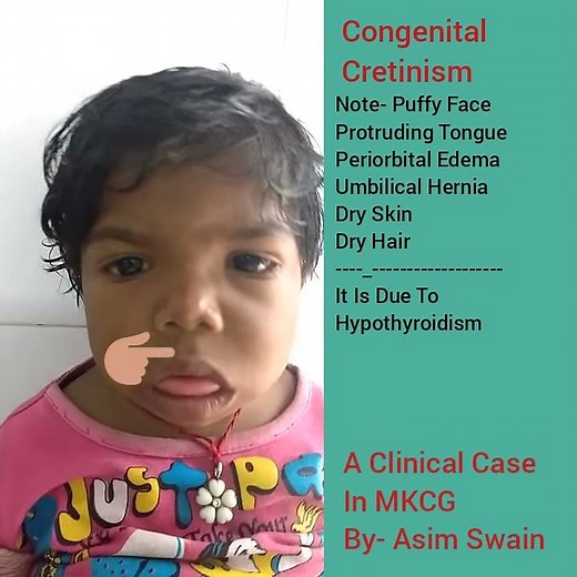 Congenital cretinism: A clinical case in MKCG by asim Swain