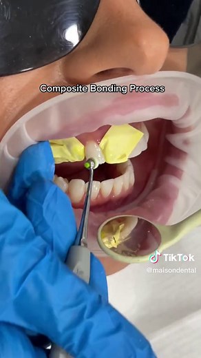Enhancing Smiles with Composite Bonding by Dr. Danya