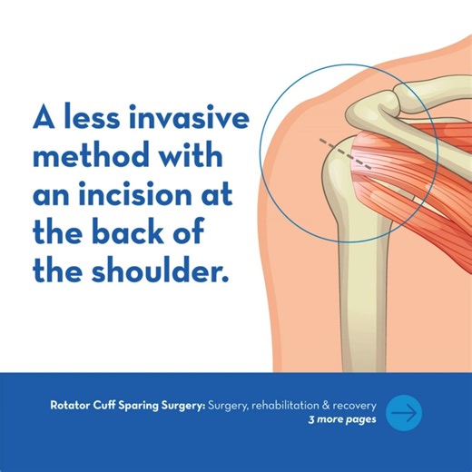 Learn more about rotator cuff-sparing surgery right here! Benefits compared to traditional replacement surgery include: 💼 Faster return to work. 💊 Minimal use of pain medication. ⏳ Shorter rehabilitation timelines. 💪 Pain reduction. To learn more about rotator cuff-sparing surgery click here: social.stelizabeth.com/rotatorcuff1 | St. Elizabeth Healthcare