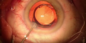 Multifocal IOL Exchange - Eyetube