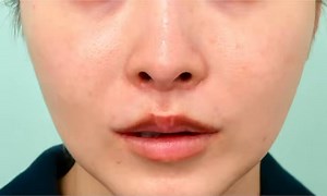 【内視鏡フェイスリフトの世界の立ち位置】海外ではすでに一分野として主流になりつつある術式ですが、日本ではまだ発展途中の分野です。お腹の手術も内視鏡が主流になりつつありますが、時代は変わっていくものです。最近の国際学会では、フェイスリフト関連演題の約1/3が内視鏡手術という印象です。ちなみに海外では「内視鏡前額リフト」をベースにポニーテール・フェイスライン・ネックを組み合わせるという設計が一般的。そのため、1000万-2000万円と手術費用が高額になることも少なくありません。それだけ評価されている術式ですが、日本でも、こだわりを持って行えばより現実的な費用で提供することが可能です。✔ できるだけダウンタイムを抑え✔ でも効果はしっかりそのバランスを大切にしています。【30代女性】術前／術後1週間内視鏡ポニーテールリフト＋フェイスラインリフトほうれい線がやわらぎ、フェイスラインがすっきりと逆三角形に。自然で確実な変化を目指しています。