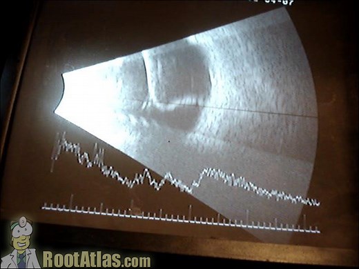 Retinal detachment viewed from the slitlamp (Video) - TimRoot.com