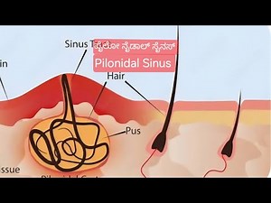 Pilonidal Sinus