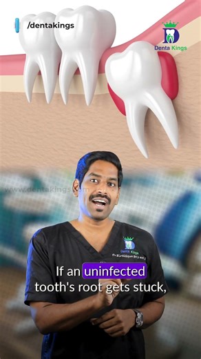 ஞானப்பல்லின் வேர் நுனியை கண்டிப்பா எடுக்கணுமா? - Do we need to remove the root of the wisdom tooth