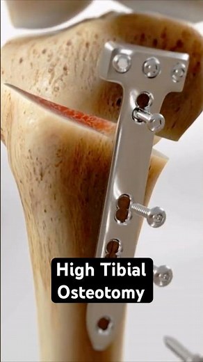 Fixing a misaligned knee (3D Animation)