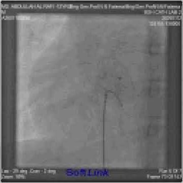 Abdullah Al Rafi 12 Y 52Kg ASD device closure done