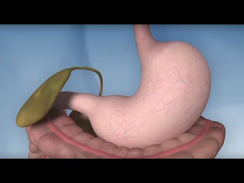 Gastric Bypass Complications - Mayo Clinic