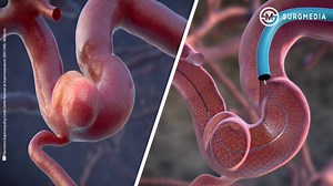 Visualization of the blood flow on an aneurysm and the effect of the embolization device, over the blood flow inside an artery. | SurgMedia