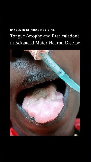 Images in Clinical Medicine: Tongue Scalloping and Fasciculations