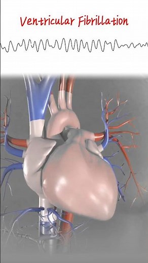 How DC cardioversion saves Heart #shorts #ecg #defibrillation #ventricularfibrilation #cardiology