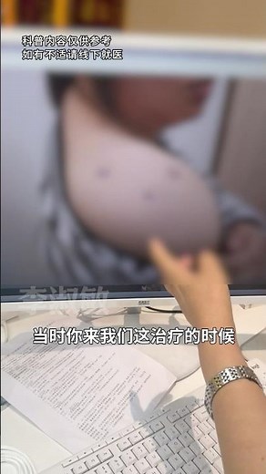 肩膀疤痕疙瘩，保守治疗一次上岸💪#Scar #ScarRemoval #Keloid #瘢痕疙瘩 #疤痕 #skincare #疤痕增生 #疤痕体质 #疤痕疙瘩 #浅放 #手术疤痕 #蟹足肿