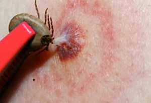 Tick bites on Humans – Images, Symptoms, Causes, Treatment